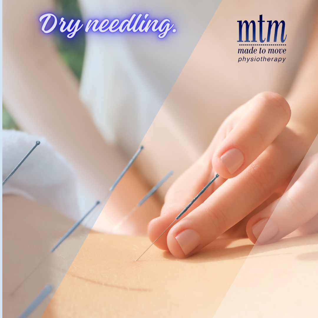 Dry Needling and Accupuncture